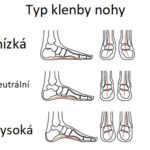 Propadlá klenba aneb proč vaše nohy „ztrácejí dech“ a jak jim vrátit lehkost?