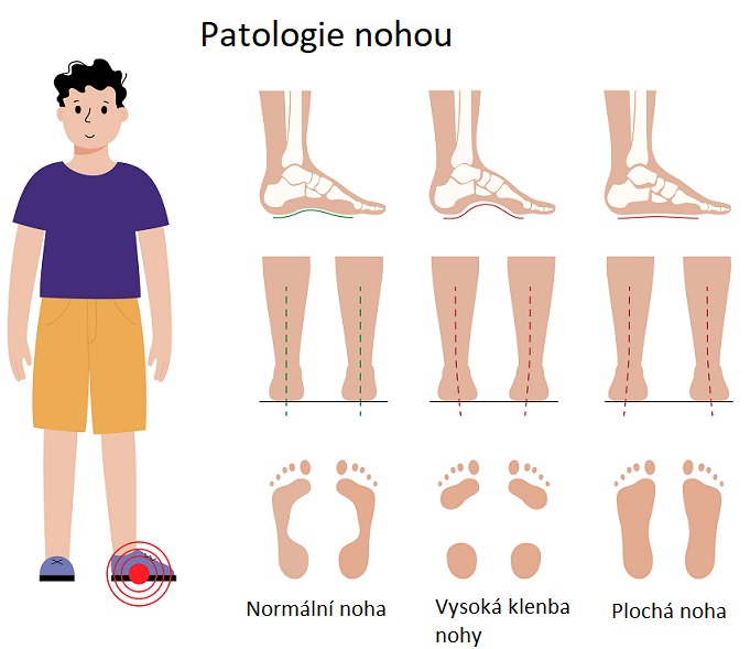 Patologické stavy nohy - ilustrace