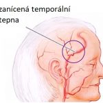 Temporální arteritida (Hortonova nemoc) – co je to – příznaky, příčiny a léčba