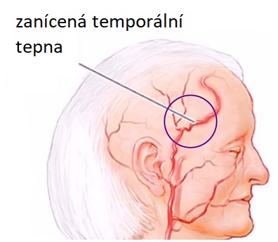 Temporální arteritida (aneb zánět spánkové tepny aneb Hortonova nemoc) je neinfekční zánětlivé onemocnění.