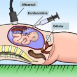 Kordocentéza – co je to – příznaky, příčiny a léčba