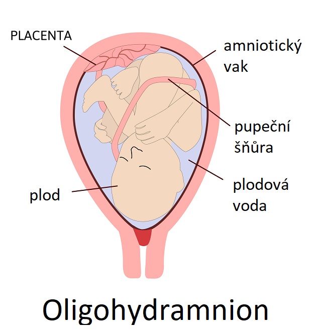 Oligohydramnion - ilustrace