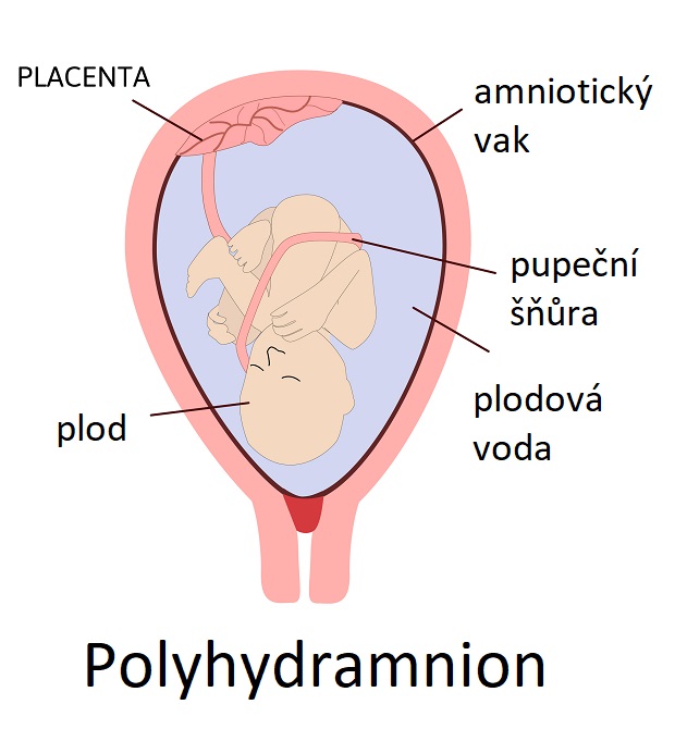 Polyhydramnion - ilustrace