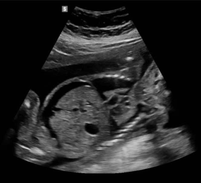 Hydrops fetalis ve 20. týdnu těhotenství
