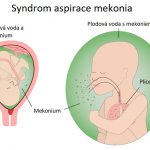 Syndrom aspirace mekonia – co je to – příznaky, příčiny a léčba