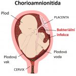 Chorioamnionitida – zánět plodových obalů (choria, amnia) – příznaky, příčiny a léčba