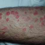 Erythema multiforme (Multiformní erytém) – co je to – příznaky, příčiny a léčba