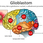 Glioblastom – co je to – příznaky, příčiny a léčba