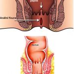 Řitní trhlina (anální fisura, anální trhlina) – co je to – příznaky, příčiny a léčba