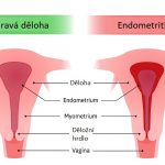 Zánět dělohy (endometritida) – jak se léčí? Příznaky a příčiny