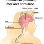 Hloubková (hluboká) mozková stimulace – jaké má účinky?