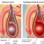 Orchitida (zánět varlat) – příznaky, příčiny a léčba