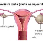 Ovariální cysta (cysty na vaječníku) – příznaky, příčiny a léčba