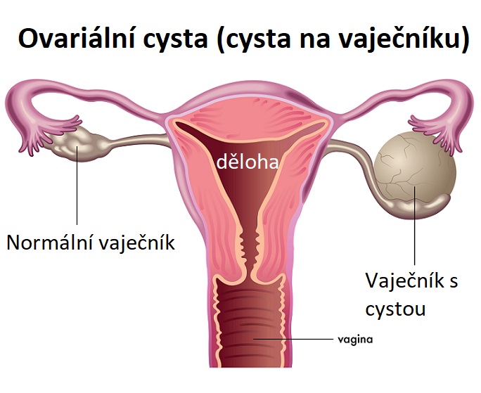 Ovariální cysta (cysta na vaječníku) - ilustrace