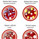 Co je to sepse – příznaky, příčiny a léčba