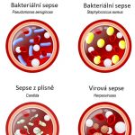 Novorozenecká (neonatální) sepse – příznaky, příčiny a léčba