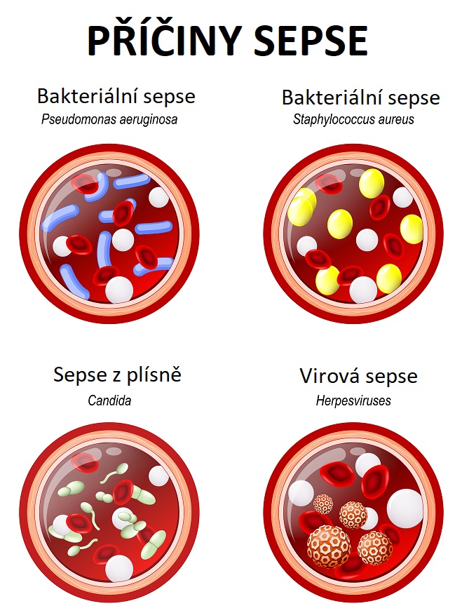 Příčiny sepse
