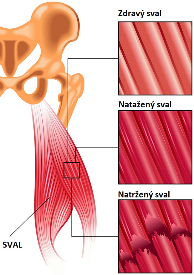 Natažení svalu x natržení svalu - ilustrace