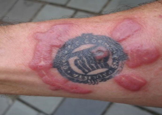 Infekce po tetování