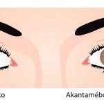 Akantamébová keratitida – vzácné infekční onemocnění rohovky – příznaky, příčiny a léčba