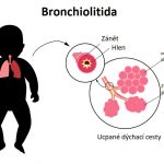 Bronchiolitida (zánět průdušinek) – co je to? Příznaky, příčiny a léčba – a jak se liší od bronchitidy?