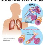 Chronická bronchitida – co je to – příznaky, příčiny a léčba