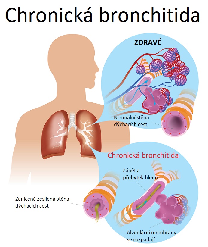 Chronická bronchitida je chronický zánět průdušek, při kterém v průduškách vzniká značné množství hlenu.