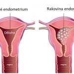 Rakovina endometria (karcinom děložní sliznice) – co je to – příznaky, příčiny a léčba