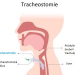 Tracheostomie – co je to, kdy se používá a jaký je postup?