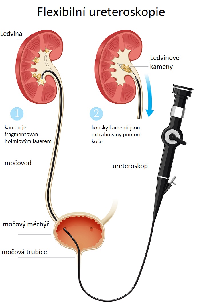 ureteroskopie - ilustrace