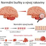 Gliomy – co je to – příznaky, příčiny a léčba