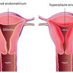 Hyperplazie endometria (děložní sliznice) – co je to – příznaky, příčiny a léčba