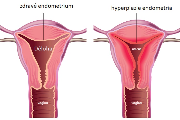 Hyperplazie endometria (děložní sliznice) - ilustrace