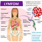 Co je to lymfom? Příznaky, příčiny a léčba lymfomu