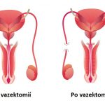 Mužská sterilizace – vazektomie – co je to? A je bezpečná?