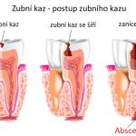 Zubní (dentální) absces – co je to – příznaky, příčiny a léčba