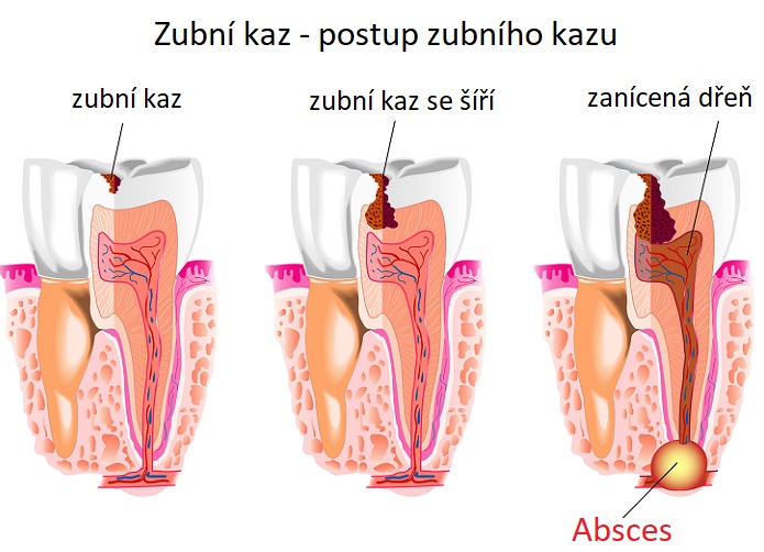 Takto může vzniknout zubní absces