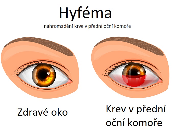 Hyféma - ilustrace