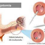 Myringotomie – co je to + kdy a jak se dělá