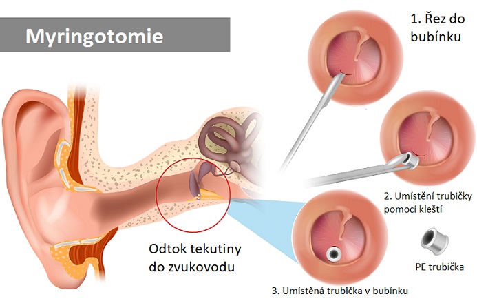 Myringotomie - ilustrace