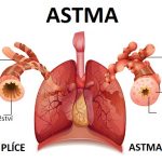 Astmatický záchvat – jak na léčbu a první pomoc?