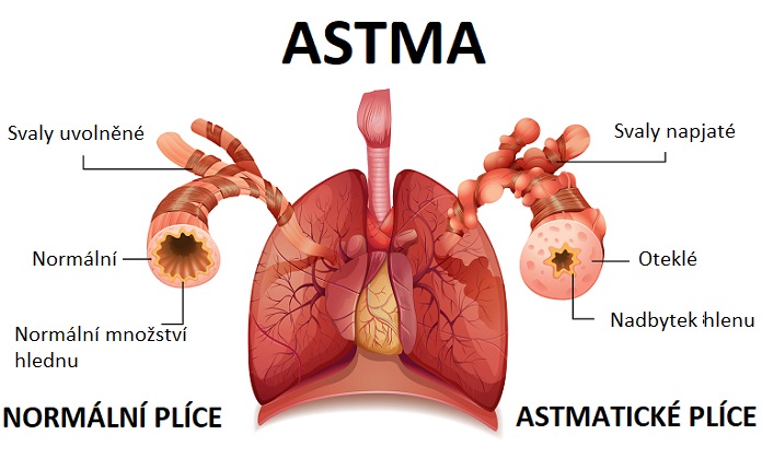 Astma - ilustrace