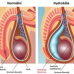 Hydrokéla (vodní kýla) – vše, co potřebujete vědět – příznaky, příčiny a léčba