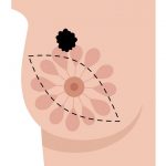 Mastektomie prsu – kompletní průvody – kdy a jak se provádí?