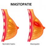 Diabetická mastopatie – co je to a proč vzniká?