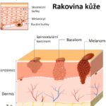 5 kroků pro prevenci rakoviny kůže – co dělat a co nedělat?