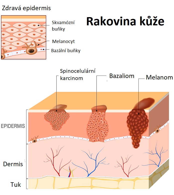 Typy rakoviny kůže - ilustrace