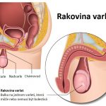 Rakovina varlat – kompletní informace – příznaky, příčiny a léčba