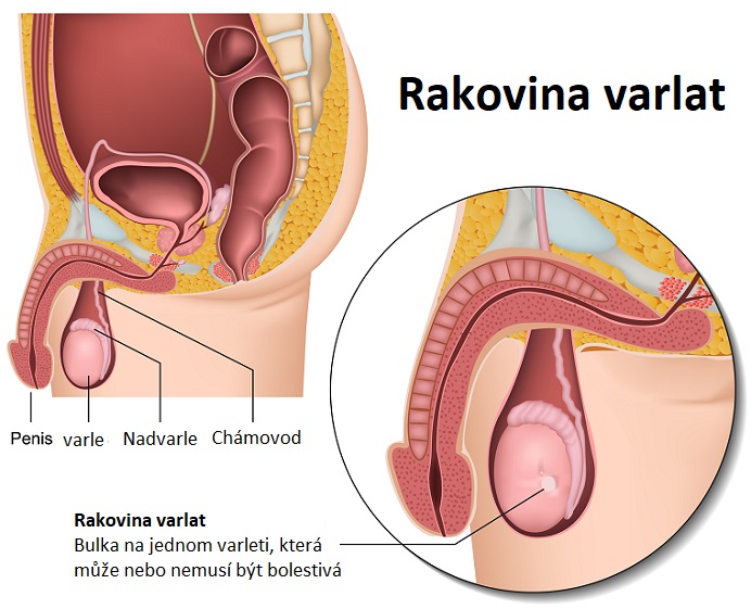 Rakovina varlat - ilustrace