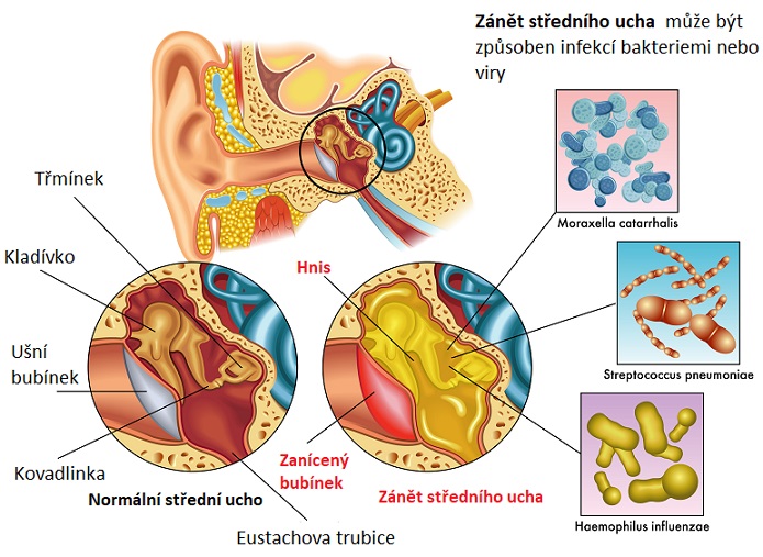 Zánět středního ucha - ilustrace